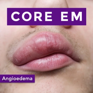 Episode 212: Angioedema