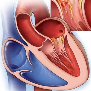 ¿Cuándo es importante indicar antibióticos en infecciones del corazón?