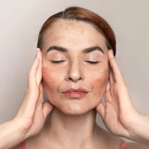 EL MELASMA, con Dra. Helga Rivera