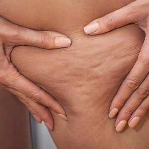 CÓMO MEJORAR RÁPIDO LA CELULITIS, con Dra. Helga Rivera