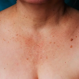ELIMINAR MANCHAS EN CUELLO Y ESCOTE, con Dra. Helga Rivera