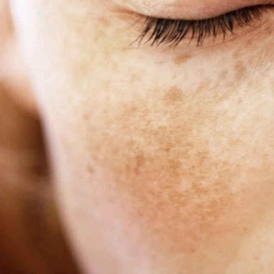 NOVEDAD EN TRATAMIENTO DEL MELASMA, con Dra. Helga Rivera