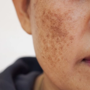 AVANCES EN EL TRATAMIENTO DEL MELASMA, con Dra. Helga Rivera