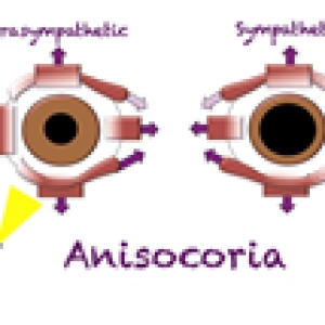 103 Anisocoria