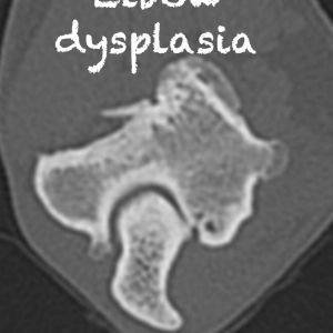 99 Elbow Dysplasia