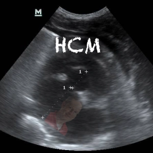 72 HCM in cats