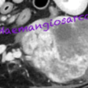 119 Haemangiosarcoma