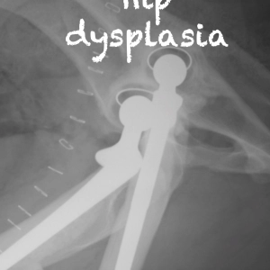 96 Hip Dysplasia