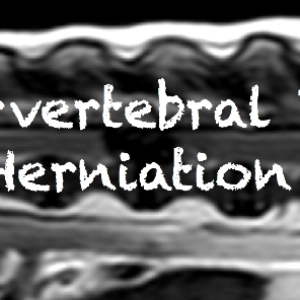 86 Intervertebral Disk Herniation