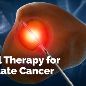Focal Therapy for Prostate Cancer: Why Who and How?