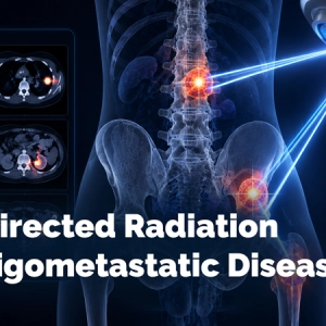 PET-Directed Radiation for Oligometastatic Disease